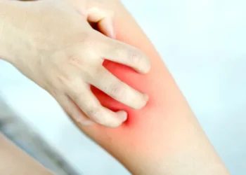 Coceira persistente nas pernas pode indicar problemas nas veias