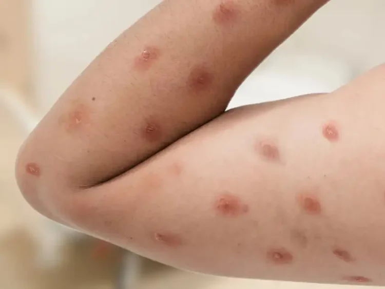 Porto Alegre confirma primeiro caso da doença em 2026