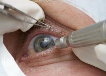 Lula faz cirurgia de catarata; entenda a doença e o procedimento